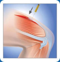 A graphic illustrating platelet-rish plasma being injected into a knee. The skin is partially transparent to show the injured muscle.